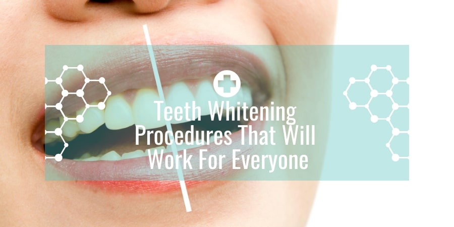 Teeth Whitening Procedures That Will Work for Everyone