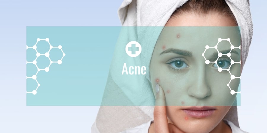 Acne Problem, Prevention and Treatment
