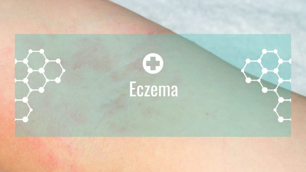 Eczema Types Causes Treatment Dubai Clinics