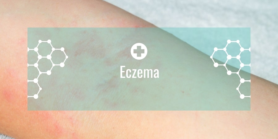 Eczema Types, Causes, Treatment