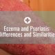 Eczema and Psoriasis: Differences and Similarities